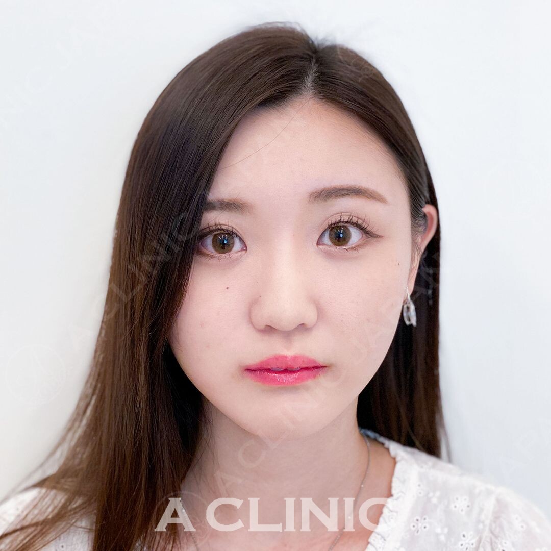 小顔と同時にほうれい線のスッキリ感も実感できます！Aスレッドの処置直後の症例です(20代女性) AFTER