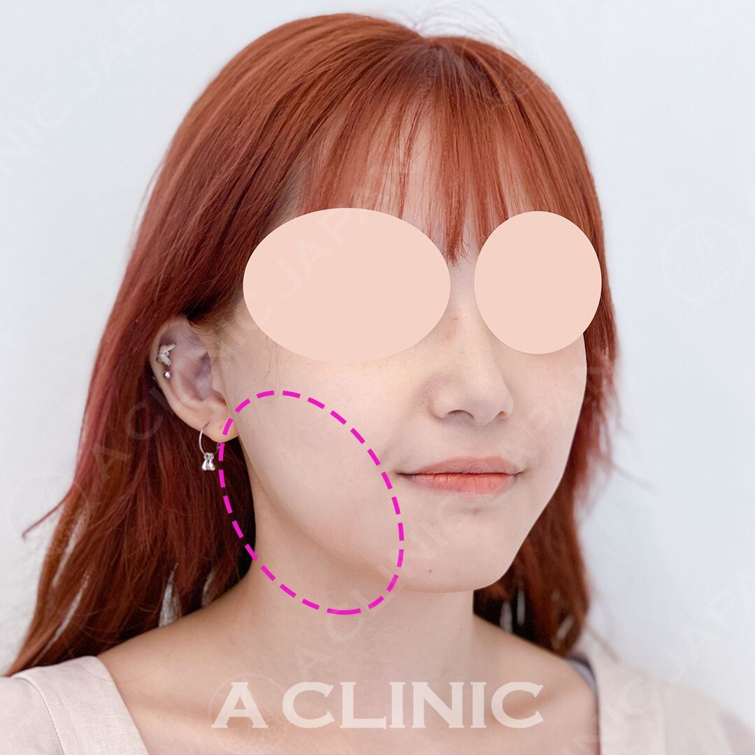 フェイスラインのもたつきを15分で解消！Aスレッドの処置直後の症例写真です(20代女性) AFTER