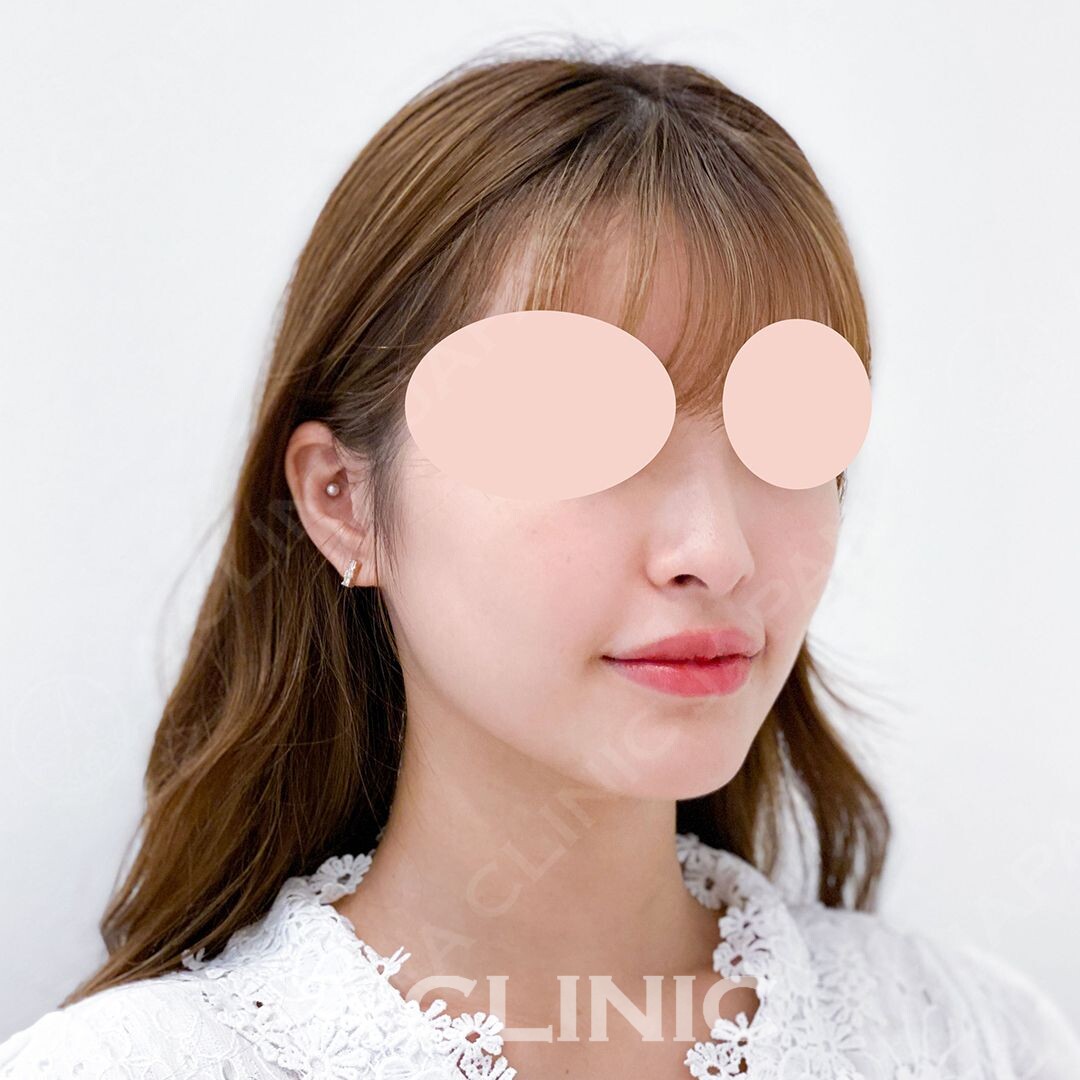 腫れずに小顔になりたい方必見です。Aスレッドで処置直後から理想の小顔に(20代女性) BEFORE