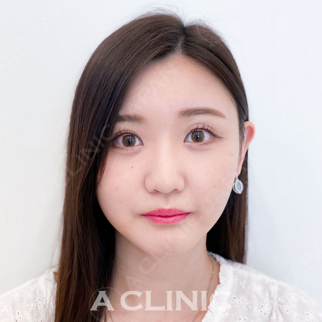 小顔と同時にほうれい線のスッキリ感も実感できます！Aスレッドの処置直後の症例です(20代女性) BEFORE