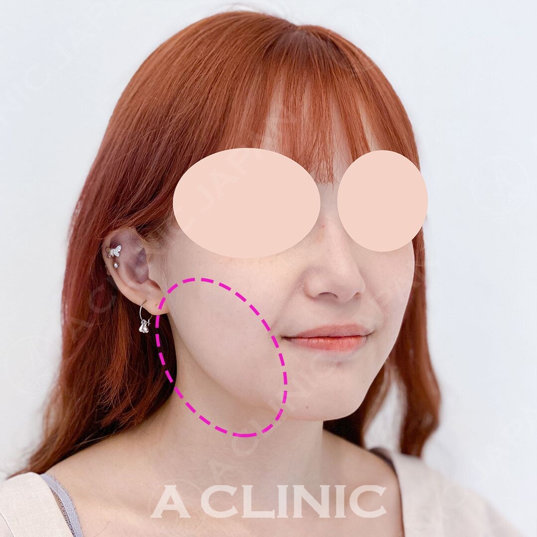 フェイスラインのもたつきを15分で解消！Aスレッドの処置直後の症例写真です(20代女性) BEFORE