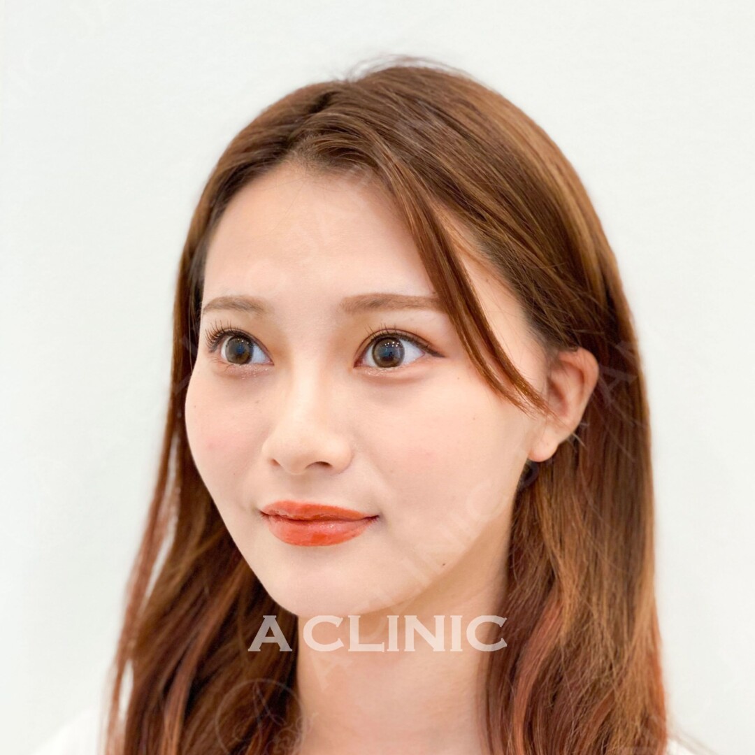 Aスレッドで憧れのVフェイスに！処置前と処置直後の症例です(10代女性) AFTER