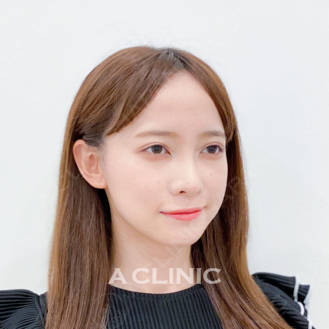 Aスレッドでもたつきがしっかりリフトアップされました！処置前と処置直後の症例です(20代女性) AFTER