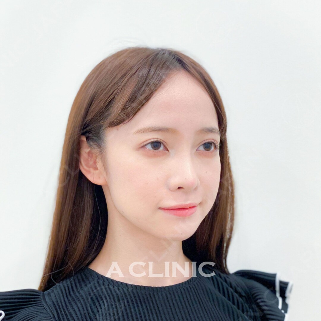 Aスレッドでもたつきがしっかりリフトアップされました！処置前と処置直後の症例です(20代女性) BEFORE