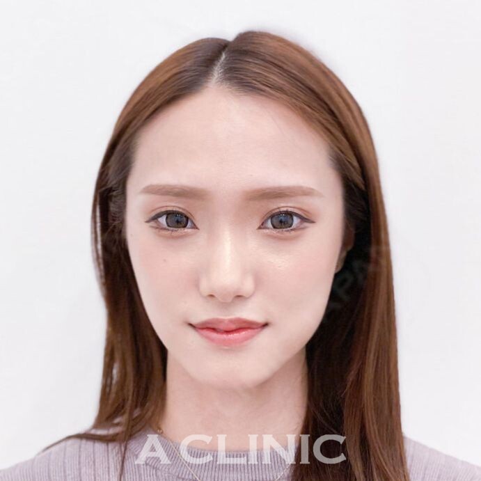 憧れのVラインフェイスになれる！Aスレッドの処置前と処置直後の症例です(20代女性) AFTER