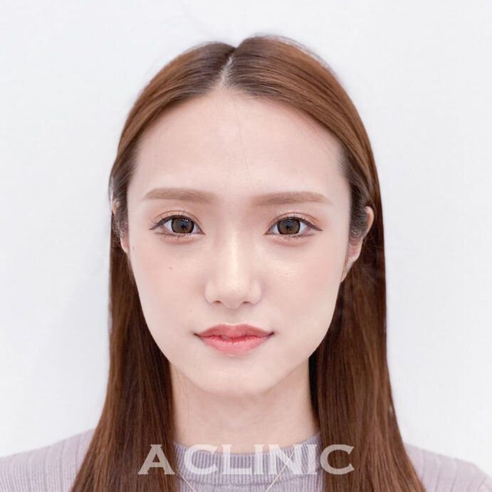 憧れのVラインフェイスになれる！Aスレッドの処置前と処置直後の症例です(20代女性) BEFORE