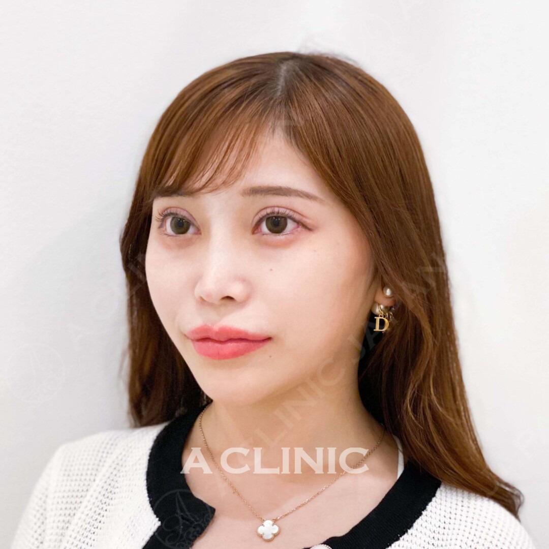 当日すぐに綺麗なフェイスラインと小顔を手に入れられます！Aスレッドの処置前と直後の症例です(20代女性) AFTER