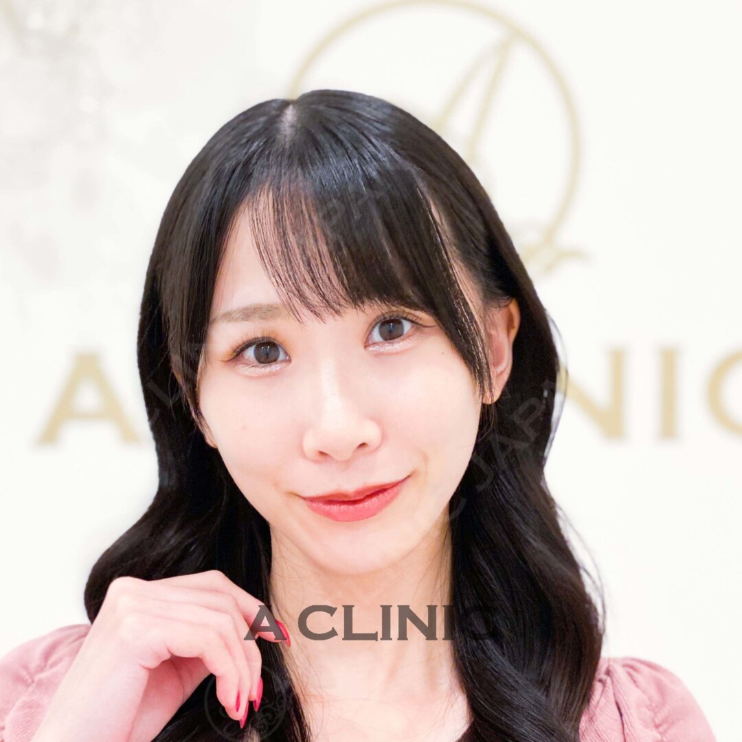 小顔になるとお顔の印象も華やかに！Aスレッドの処置前と処置直後の症例です(20代女性) AFTER