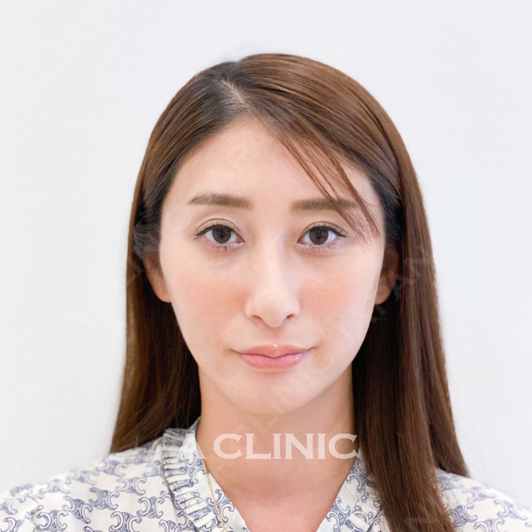 Aスレッドはたったの15分で小顔になります！綺麗な輪郭をゲット！処置前と処置直後の症例です(30代女性) BEFORE