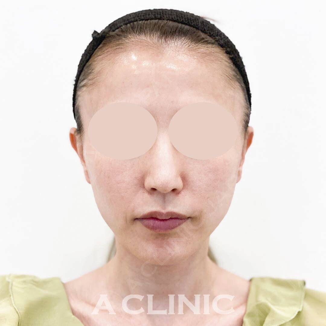 お顔のたるみやもたつきにはAスレッドがおすすめ！処置前と処置直後の症例です(30代女性) AFTER