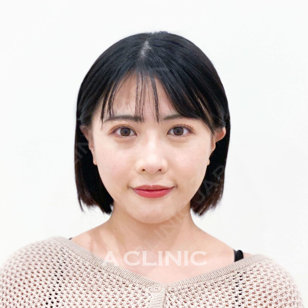 Aスレッドで口角のもたつきも即日スッキリ小顔に！施術前と術直後の症例です(20代女性) AFTER