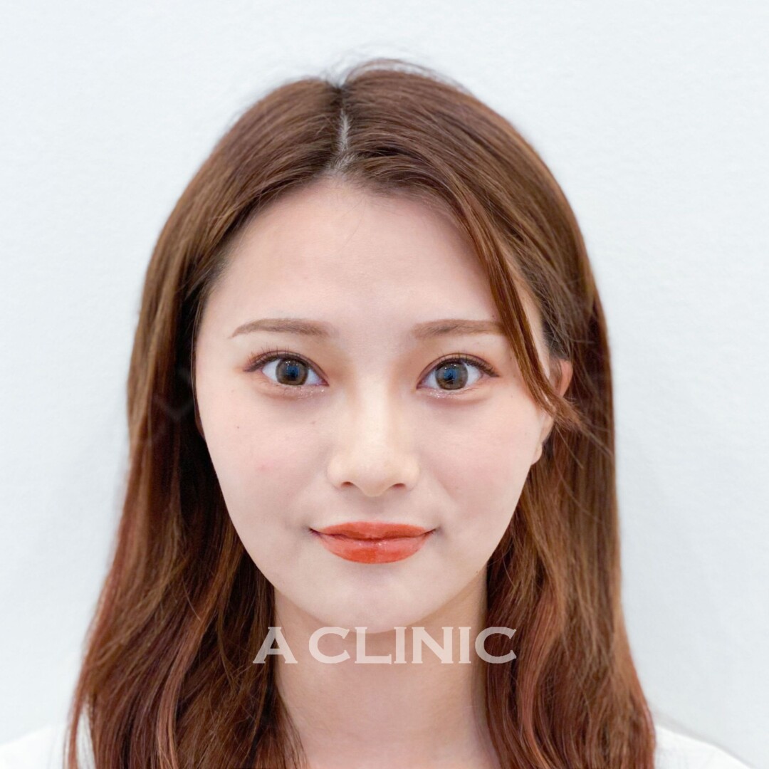 たるみやもたつきが15分で引き上がる！Aスレッドの処置前と処置直後の症例です(20代女性) AFTER