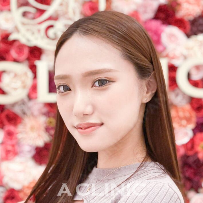 たった15分で綺麗なフェイスラインに！Aスレッドの処置前と処置直後の症例です(20代女性) AFTER