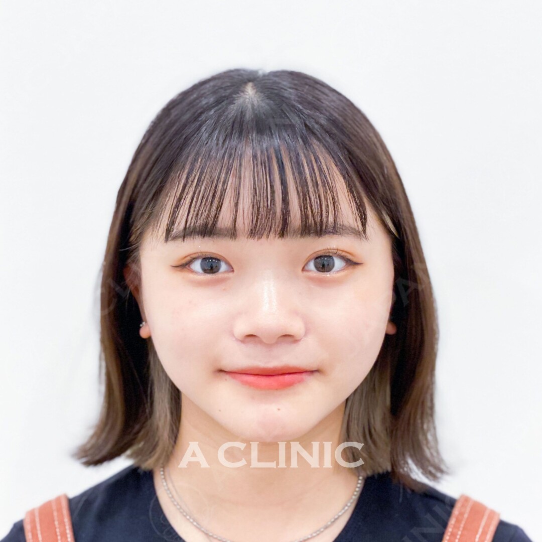 Aスレッドで輪郭をキュッと上げて整ったフェイスラインにしませんか！処置前と処置後の症例です(20代女性) AFTER