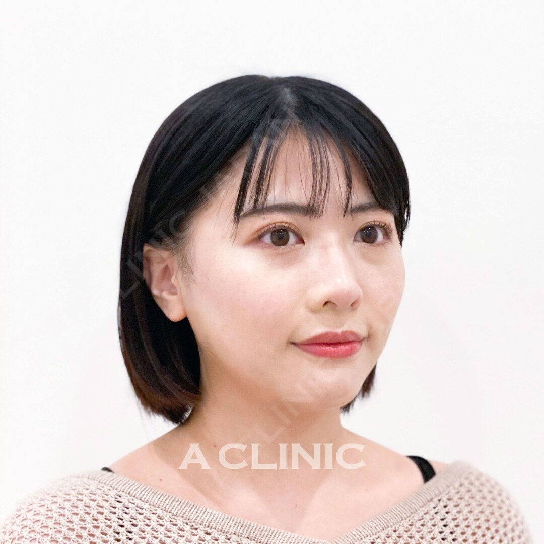 たったの15分で即日理想の輪郭に！Aスレッドの処置前と処置直後です(20代女性) AFTER