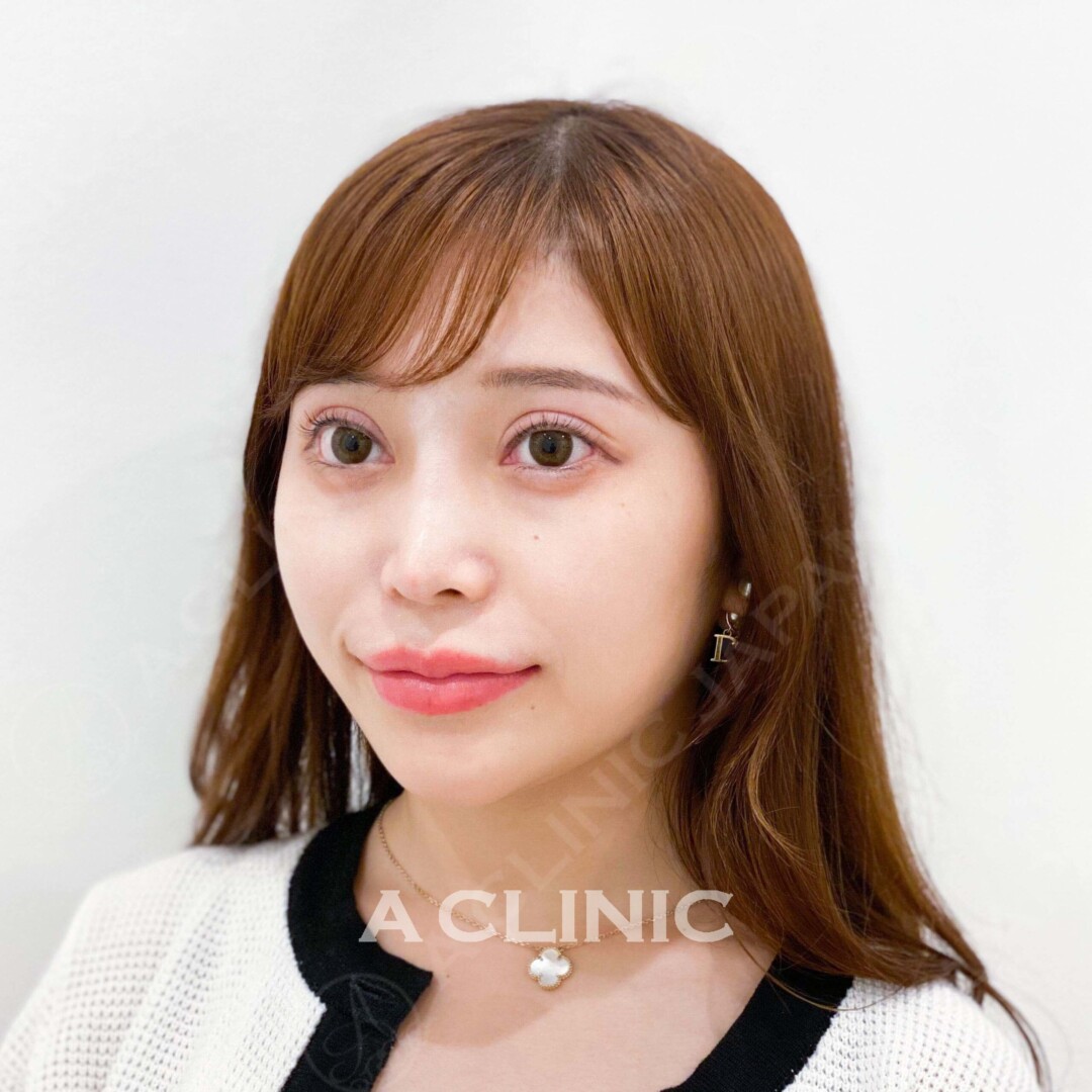 当日すぐに綺麗なフェイスラインと小顔を手に入れられます！Aスレッドの処置前と直後の症例です(20代女性) BEFORE