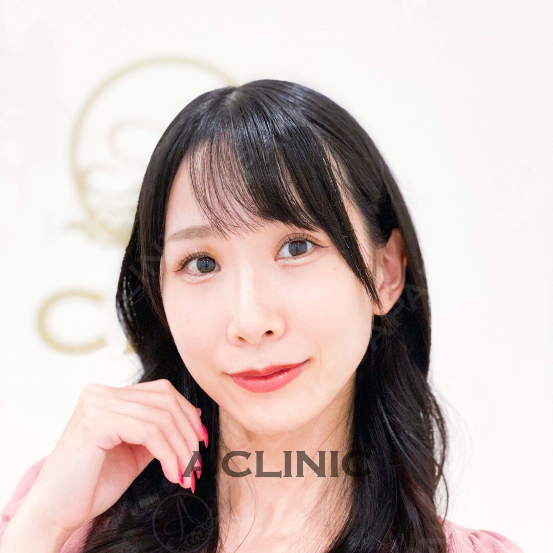 小顔になるとお顔の印象も華やかに！Aスレッドの処置前と処置直後の症例です(20代女性) BEFORE