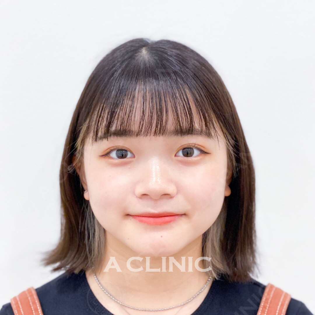 Aスレッドで輪郭をキュッと上げて整ったフェイスラインにしませんか！処置前と処置後の症例です(20代女性) BEFORE