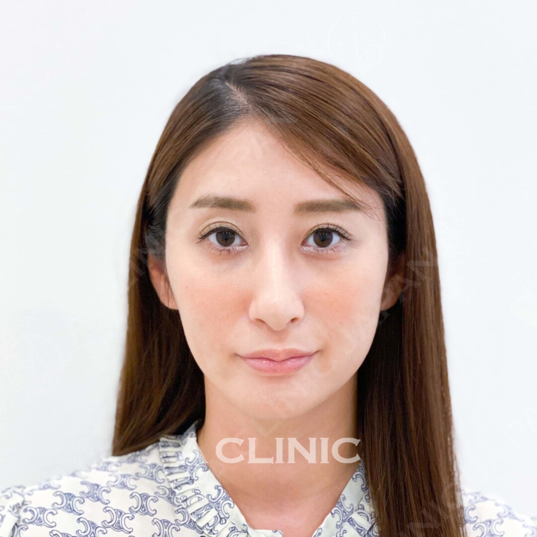 Aスレッドはたったの15分で小顔になります！綺麗な輪郭をゲット！処置前と処置直後の症例です(30代女性) AFTER