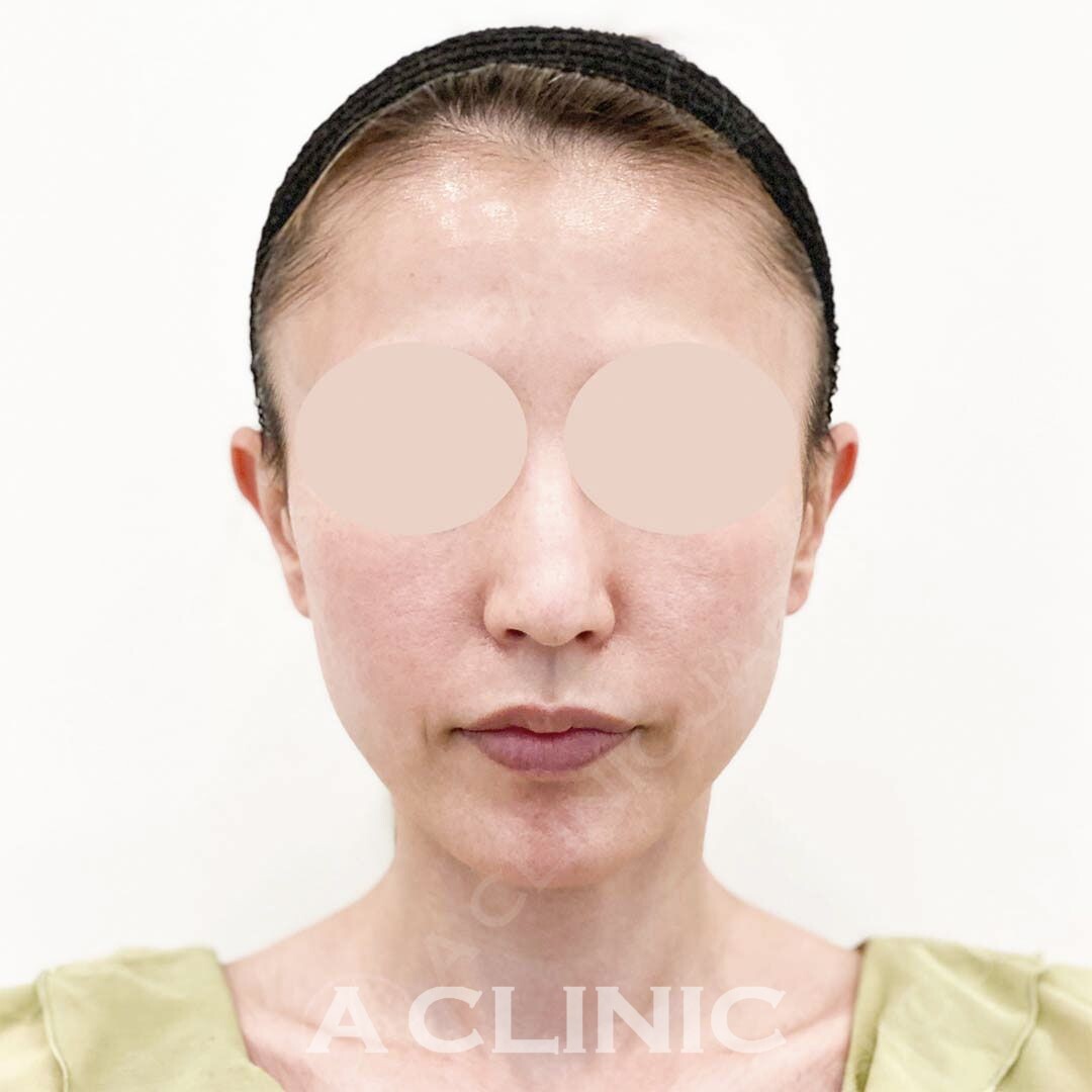 お顔のたるみやもたつきにはAスレッドがおすすめ！処置前と処置直後の症例です(30代女性) BEFORE