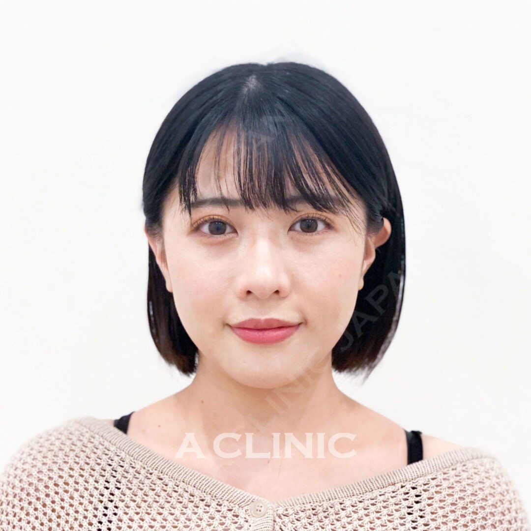 Aスレッドで口角のもたつきも即日スッキリ小顔に！施術前と術直後の症例です(20代女性) BEFORE