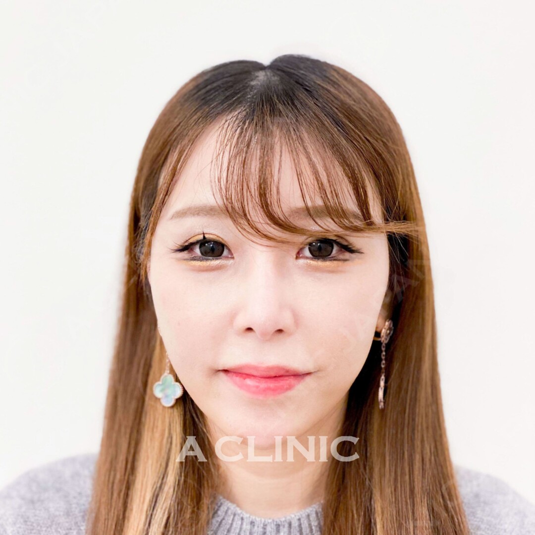 Aスレッドで綺麗なVフェイスをゲット！理想の小顔に！施術前と施術直後の症例です(20代女性) BEFORE