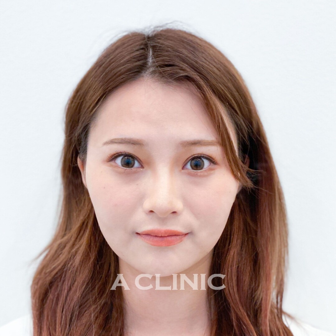 たるみやもたつきが15分で引き上がる！Aスレッドの処置前と処置直後の症例です(20代女性) BEFORE