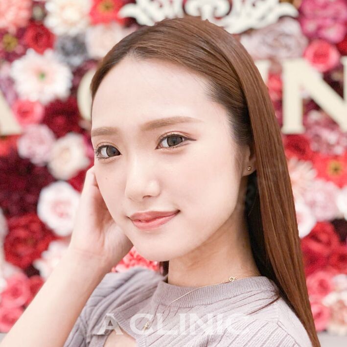 たった15分で綺麗なフェイスラインに！Aスレッドの処置前と処置直後の症例です(20代女性) BEFORE