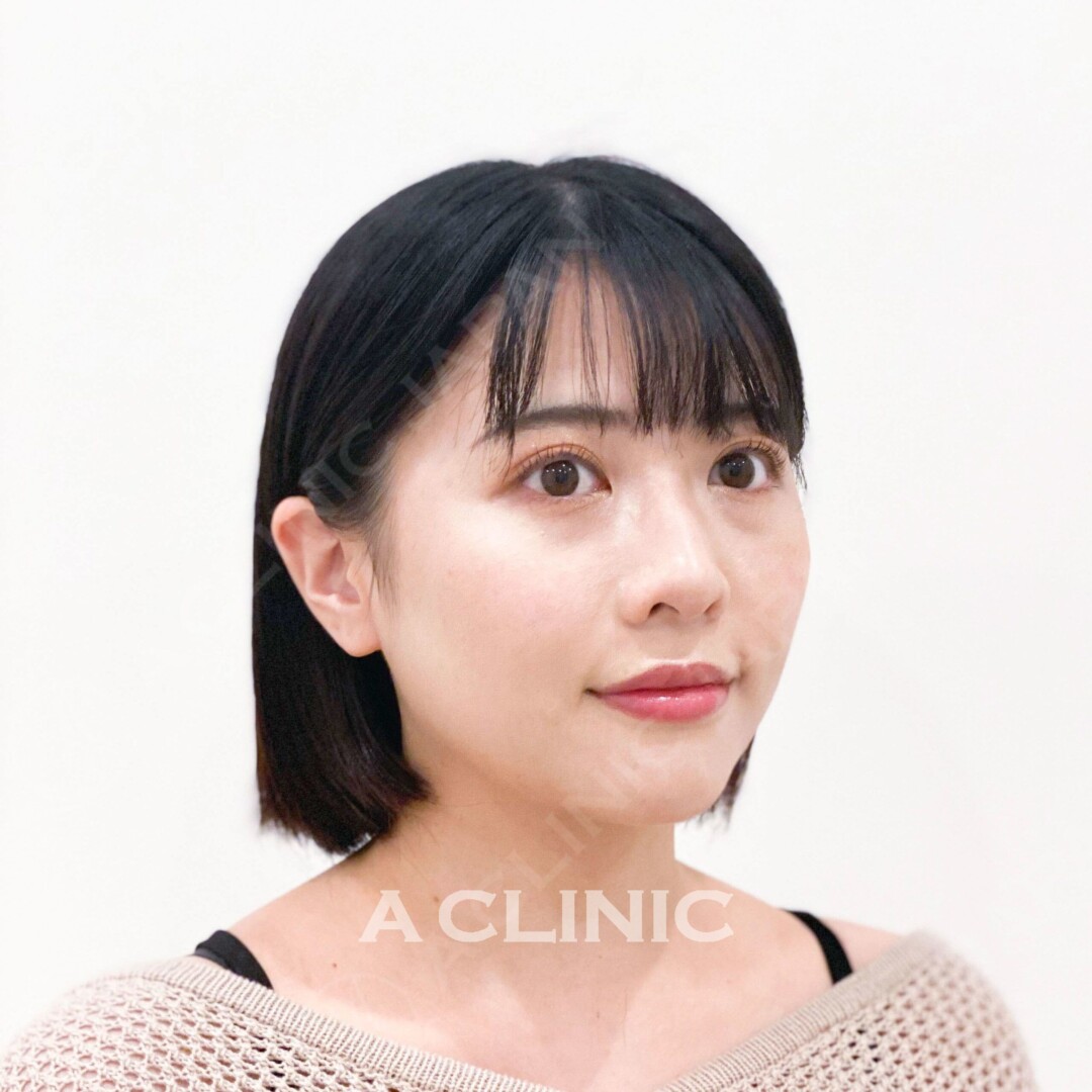 たったの15分で即日理想の輪郭に！Aスレッドの処置前と処置直後です(20代女性) BEFORE