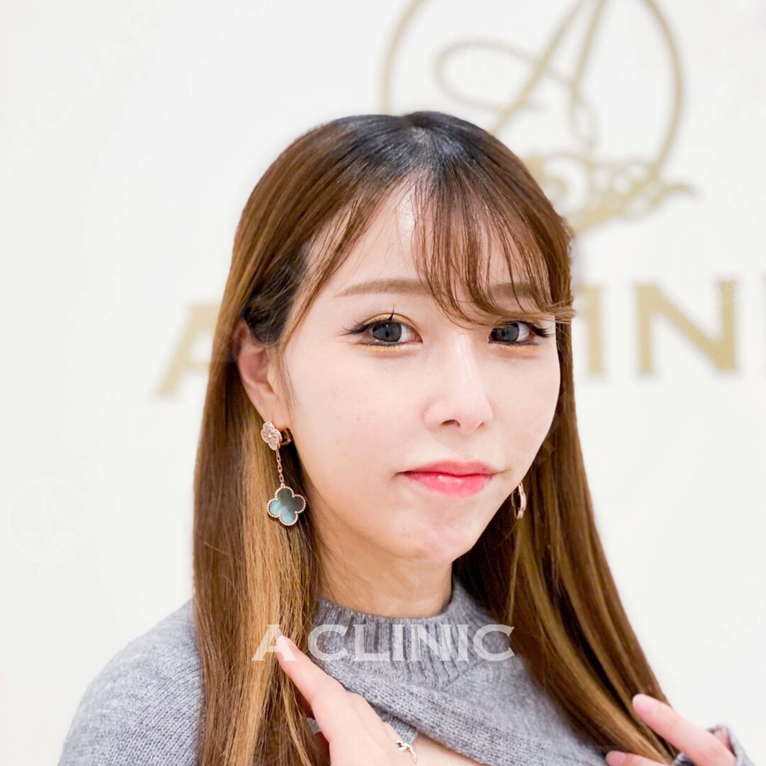 ダウンタイムはほとんどなし！即日小顔に大変身こちらAスレッドの術前と術直後の症例です(20代女性) BEFORE