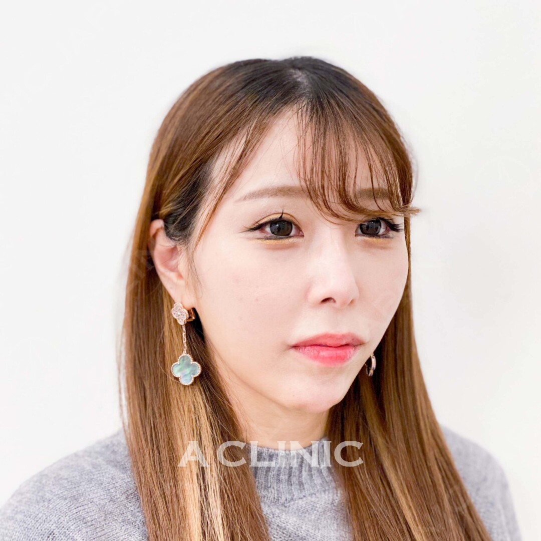 ACLINIC大人気のメニュー即日小顔になれるAスレッドの症例です！施術前と施術直後のお写真です(20代女性) BEFORE