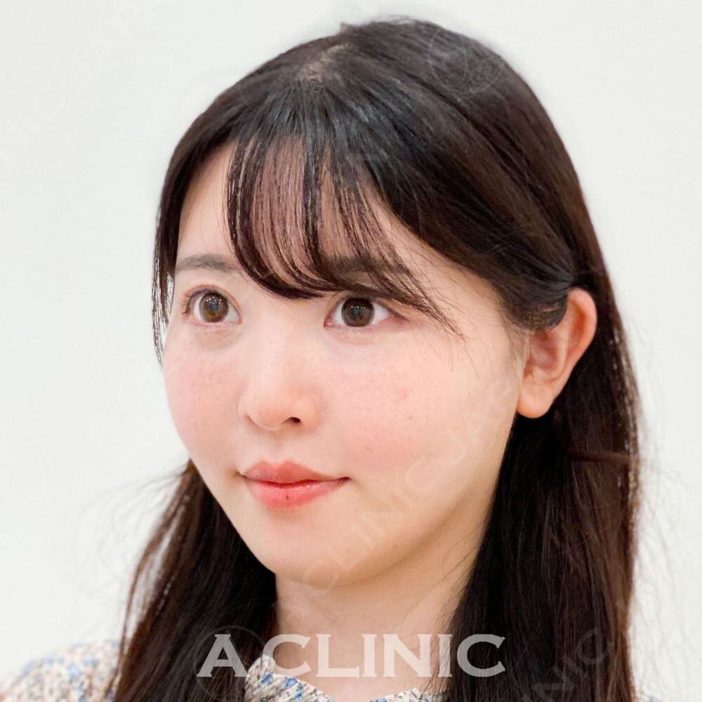 即日小顔を叶えるAスレッドで驚きの変化！処置前と処置直後の症例です(30代女性) AFTER
