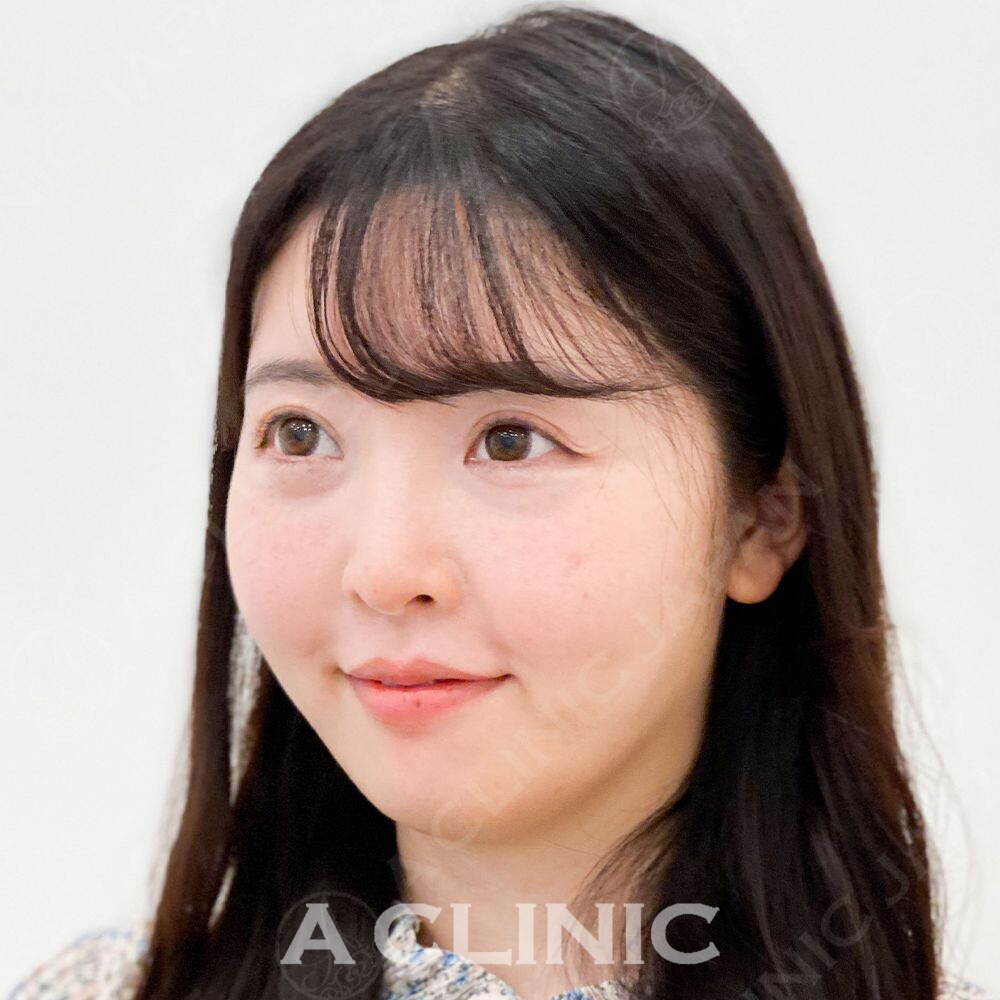 即日小顔を叶えるAスレッドで驚きの変化！処置前と処置直後の症例です(30代女性) BEFORE