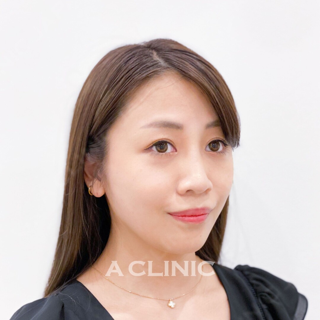 Aスレッドで憧れのたまご型フェイスになれる！処置前と処置直後の症例です(20代女性) AFTER