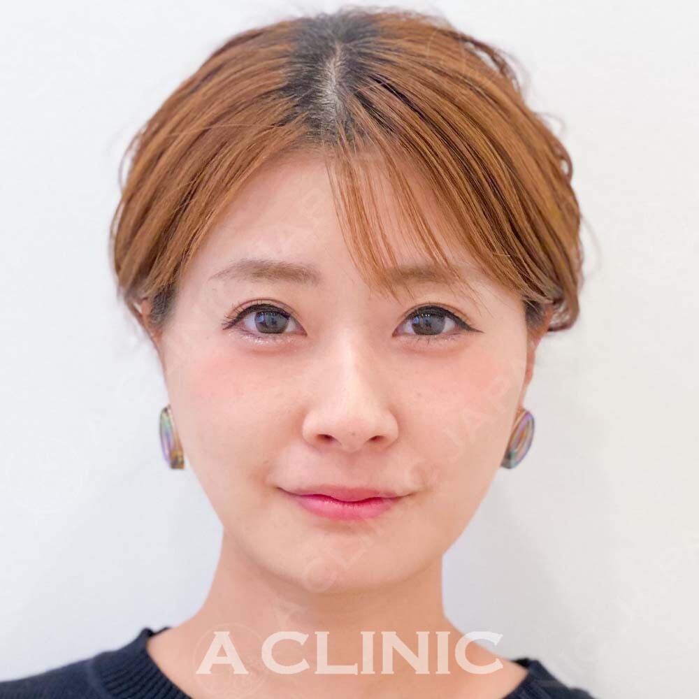 もたつき解消で理想の小顔フェイスへ！こちら処置前と処置直後の症例です(30代女性) AFTER