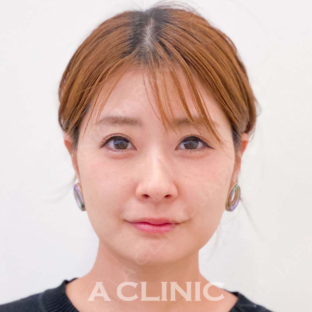 もたつき解消で理想の小顔フェイスへ！こちら処置前と処置直後の症例です(30代女性) BEFORE