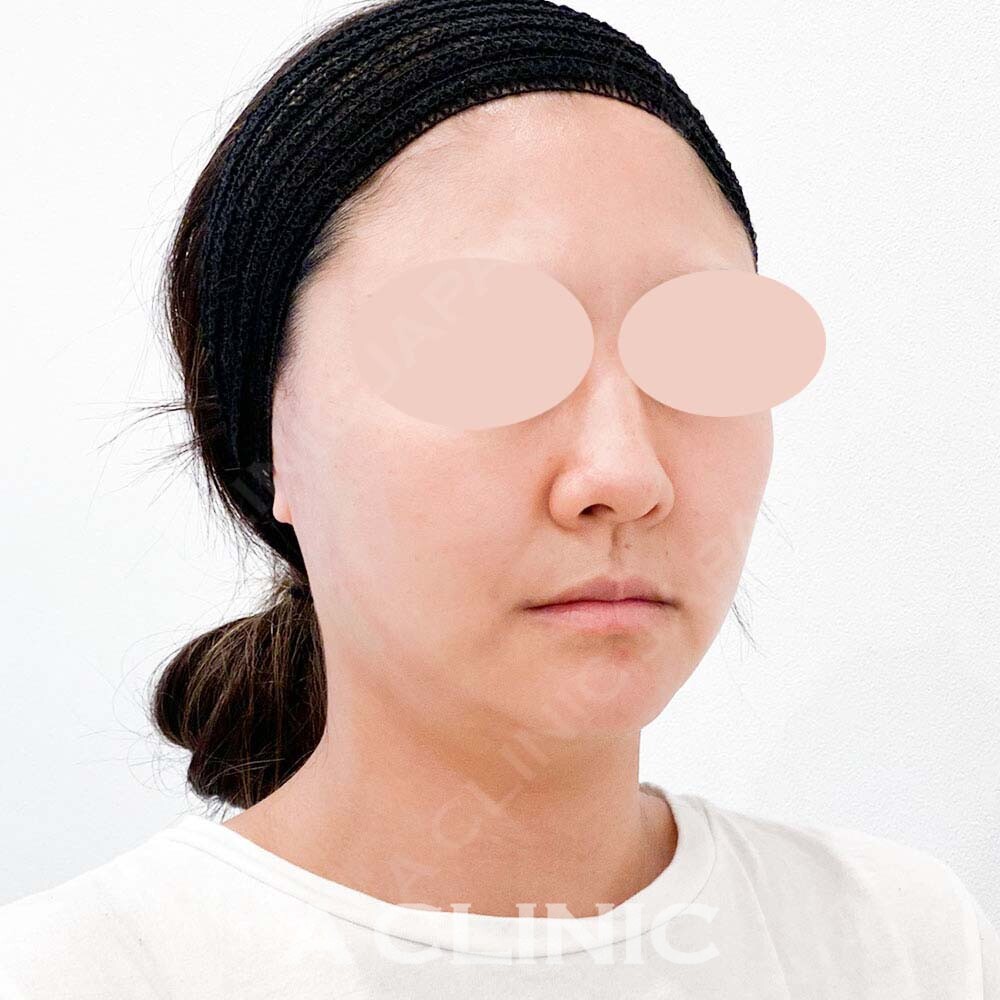 周りにバレずに自然な顔痩せ！こちらAスレッド処置前と処置直後です(30代女性) AFTER