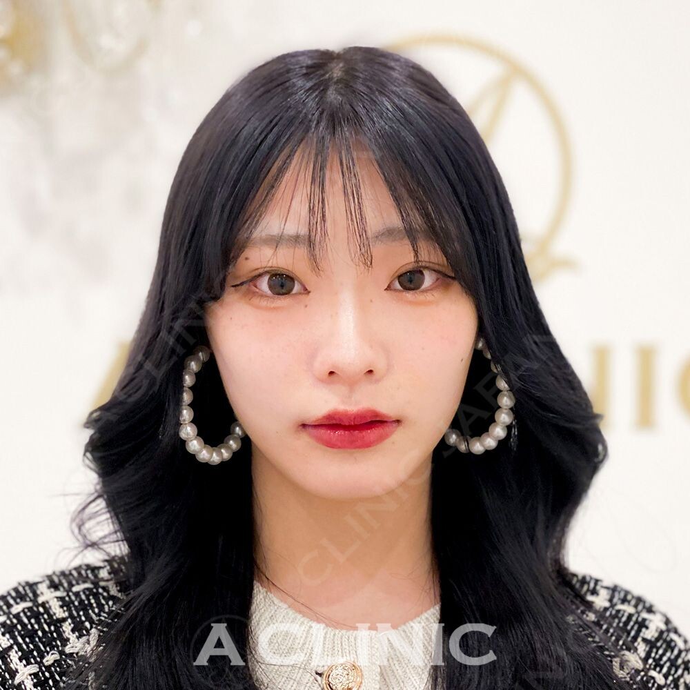 小顔や輪郭でお悩みの方にはAスレッド！処置前と処置直後の症例です(10代女性) AFTER