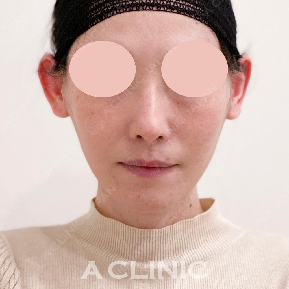 輪郭のたるみをリフトアップして若々しい印象に！Aスレッドの処置前と処置直後の症例です(40代女性) AFTER
