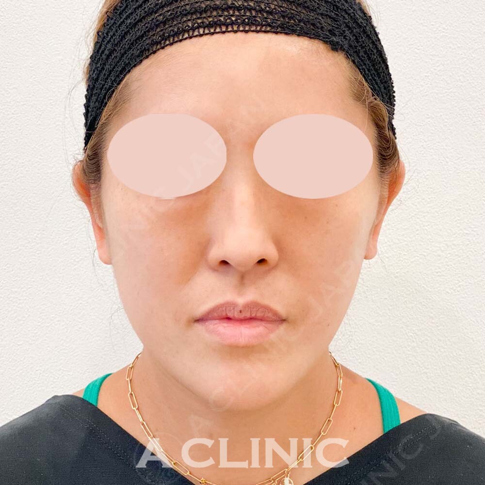 Aスレッドでもたつきを引き上げ法令線も改善！こちら処置前と処置直後の症例です(40代女性) AFTER