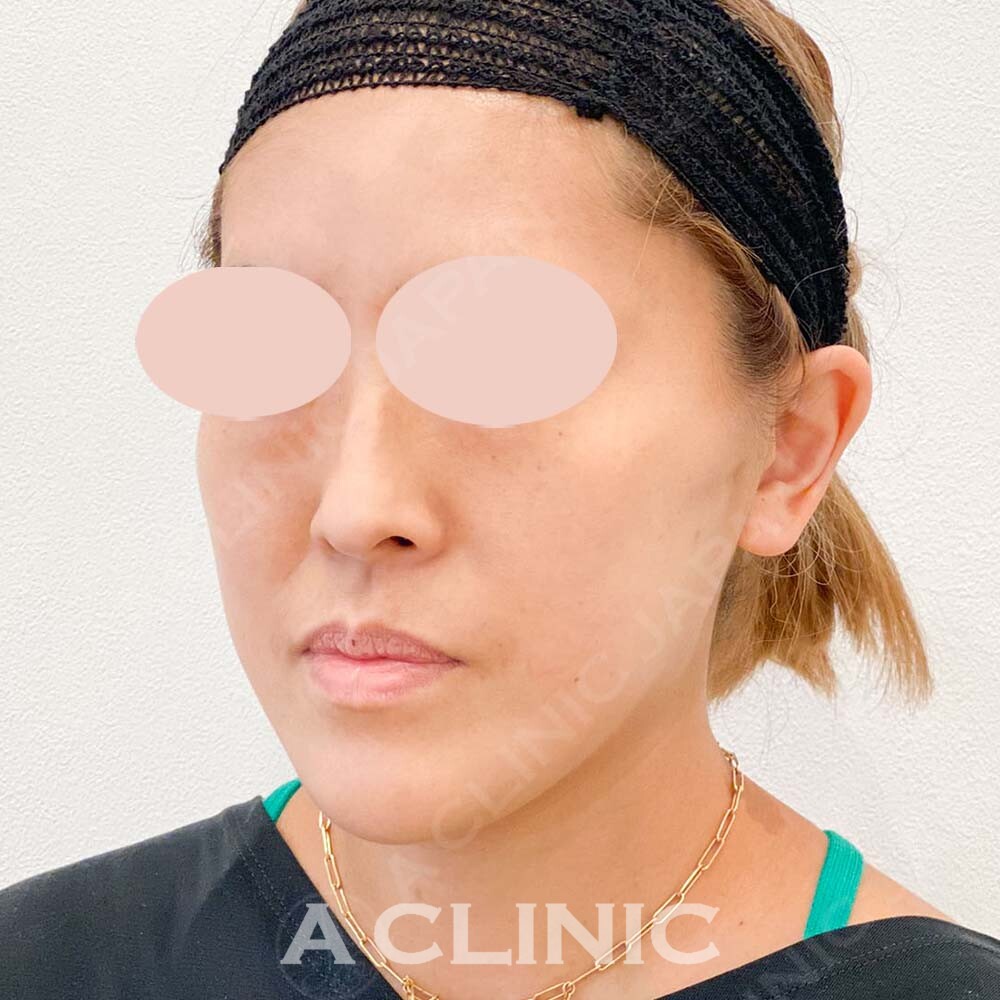 Aスレッドでエラ付近のもたつき解消！こちら処置前と処置直後の症例です(40代女性) AFTER