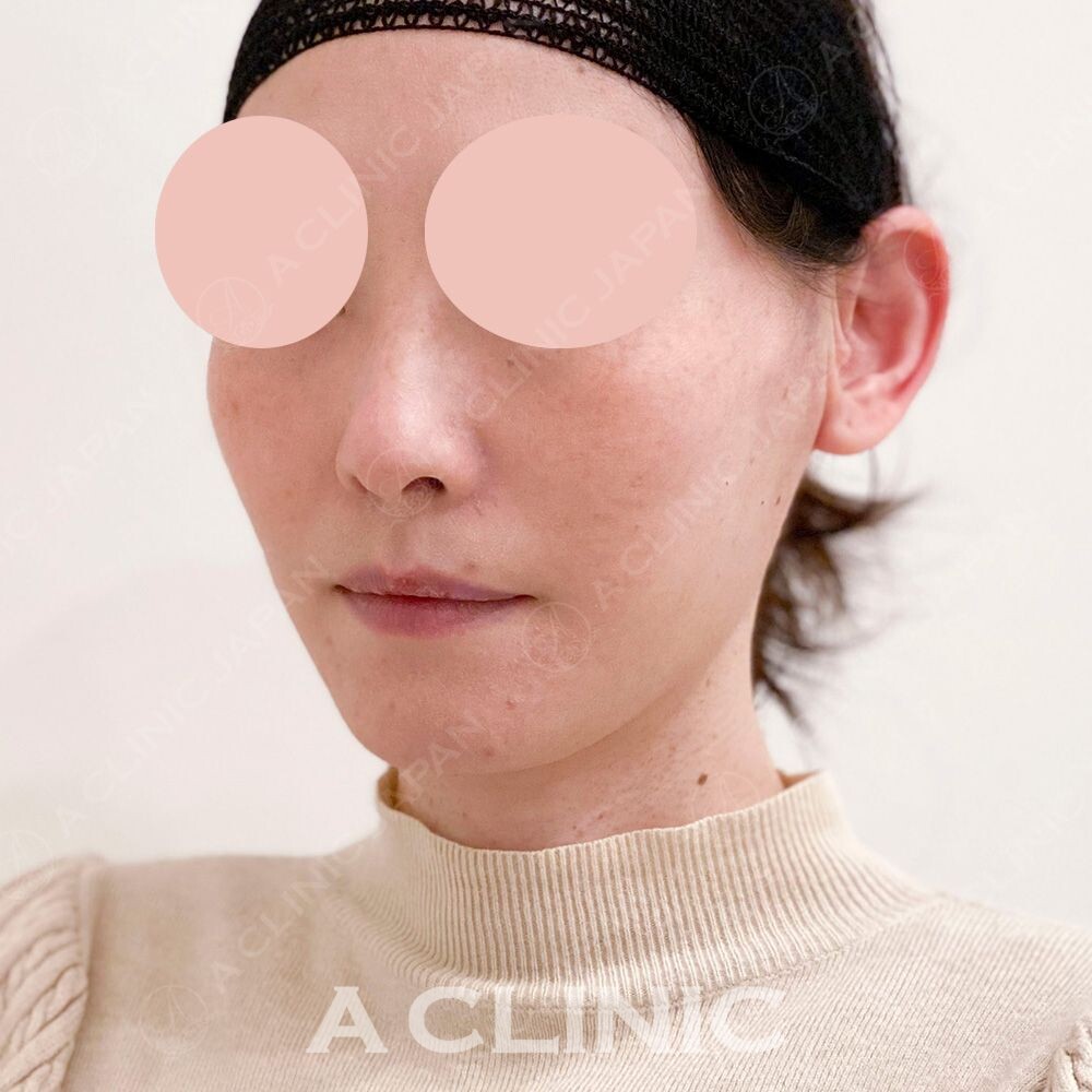 小顔になって若々しい輪郭になりましたね！Aスレッドの処置前と処置直後の症例です(40代女性) AFTER