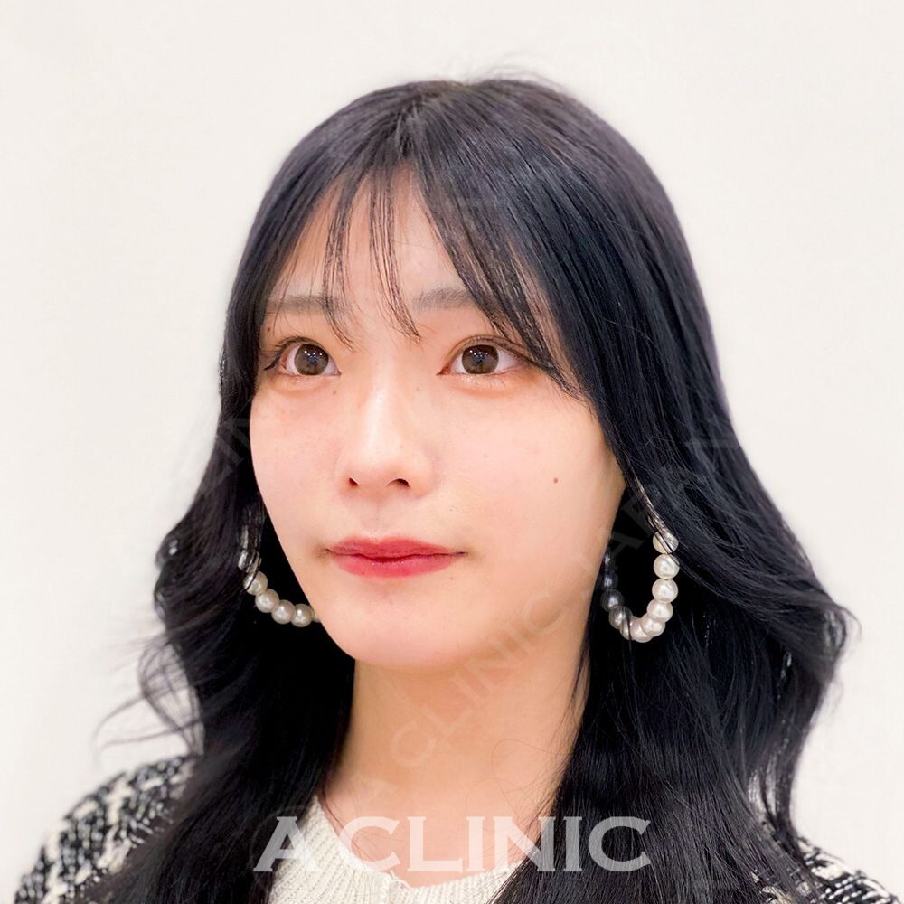 ダウンタイムや腫れがほぼない糸リフトと言えばAスレッド！処置前と処置直後の症例です(10代女性) AFTER