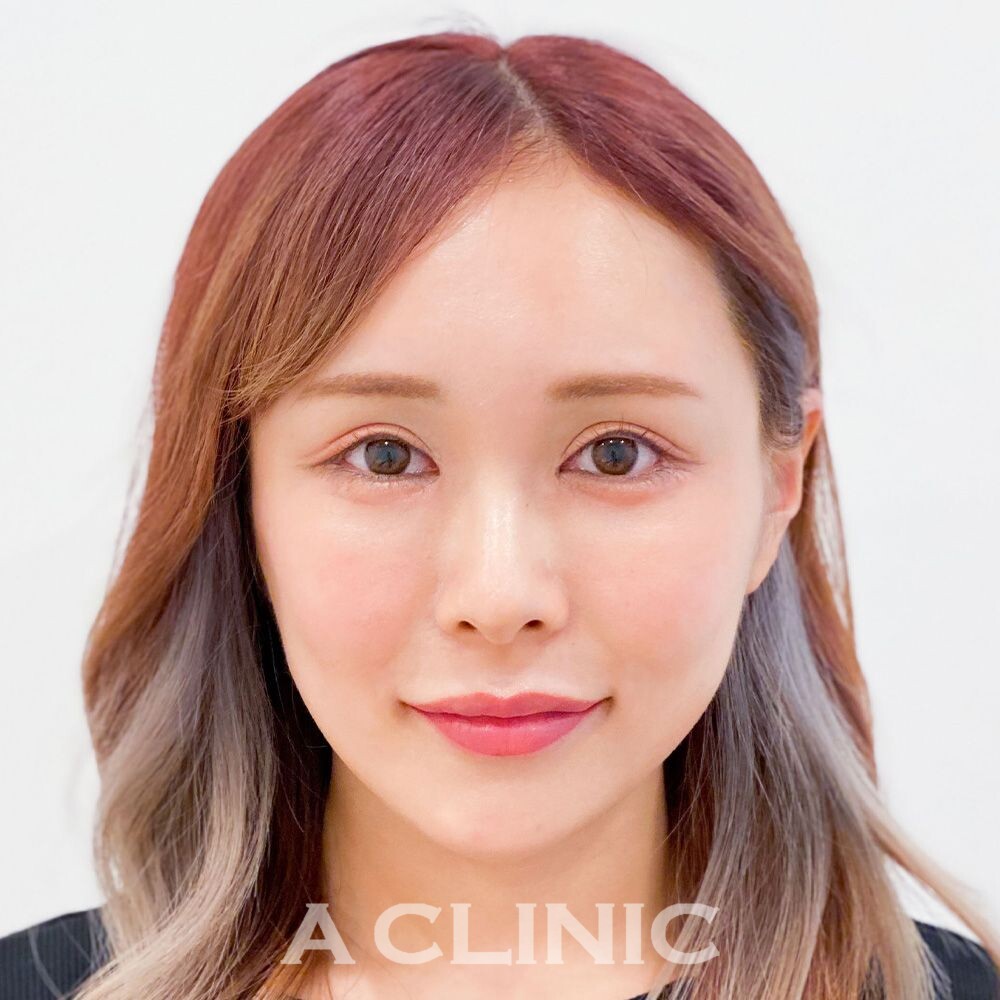 理想の小顔美人が叶うAスレッド！こちら処置前と処置直後の症例です(20代女性) AFTER