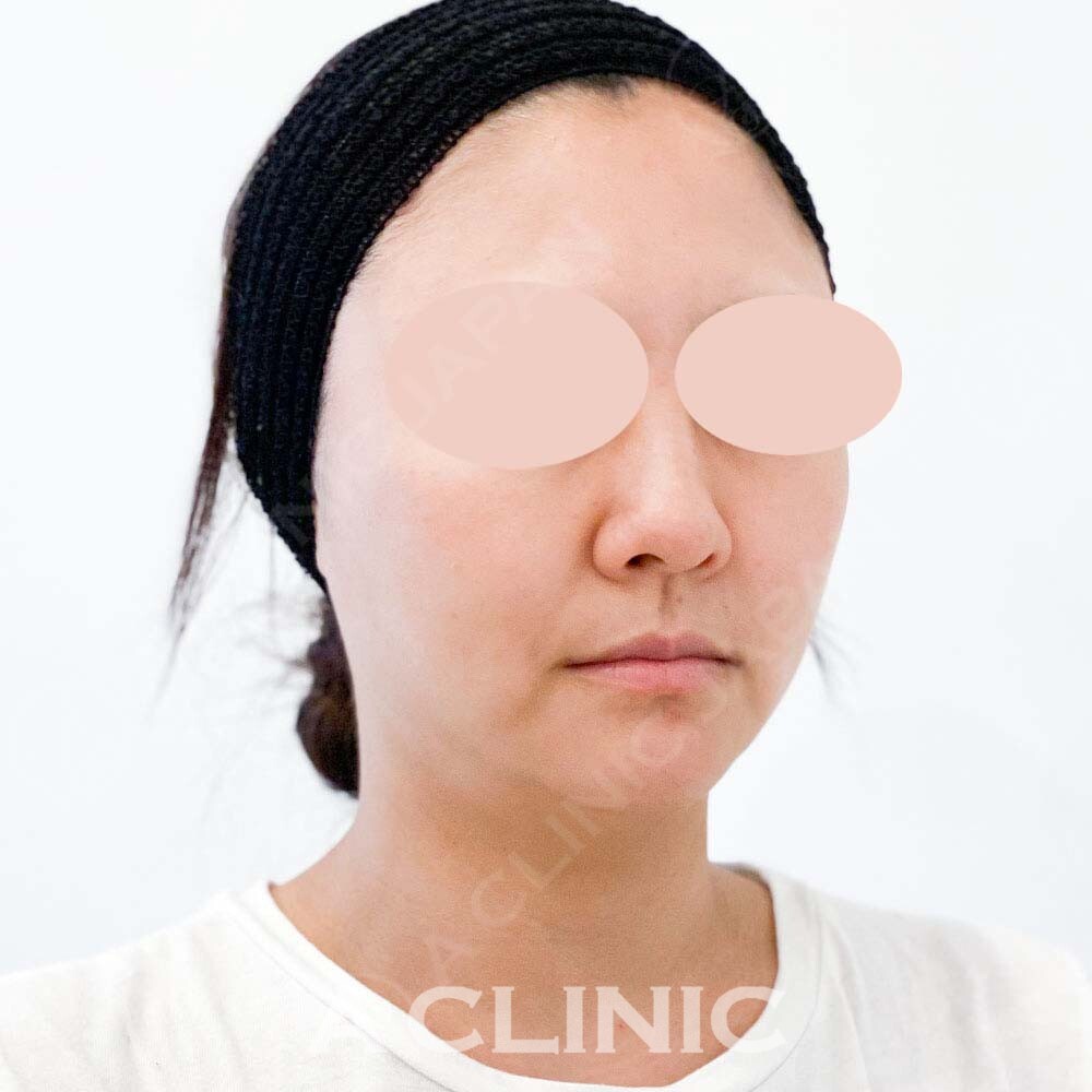 周りにバレずに自然な顔痩せ！こちらAスレッド処置前と処置直後です(30代女性) BEFORE