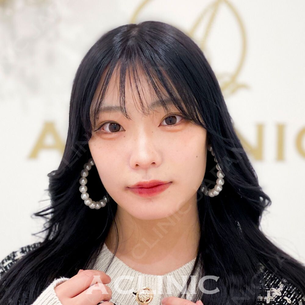 小顔や輪郭でお悩みの方にはAスレッド！処置前と処置直後の症例です(10代女性) BEFORE