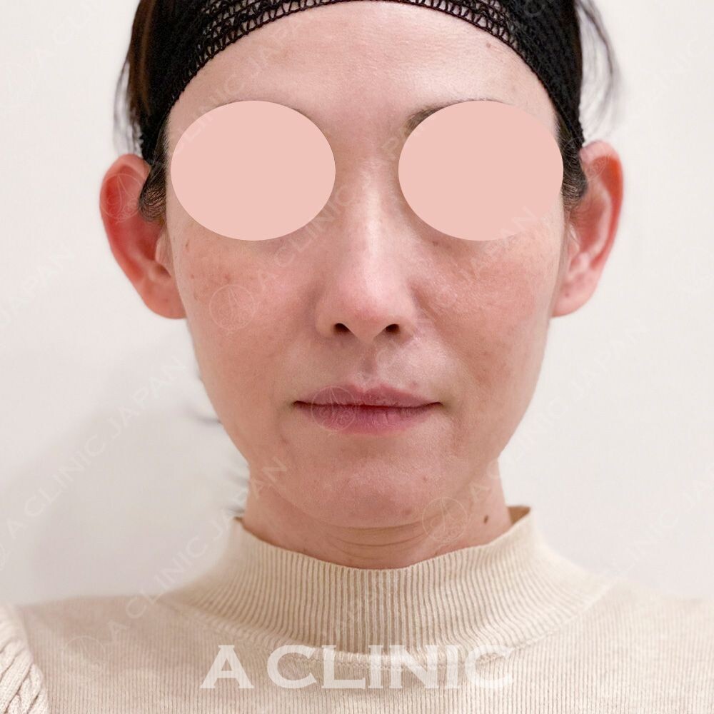 輪郭のたるみをリフトアップして若々しい印象に！Aスレッドの処置前と処置直後の症例です(40代女性) BEFORE