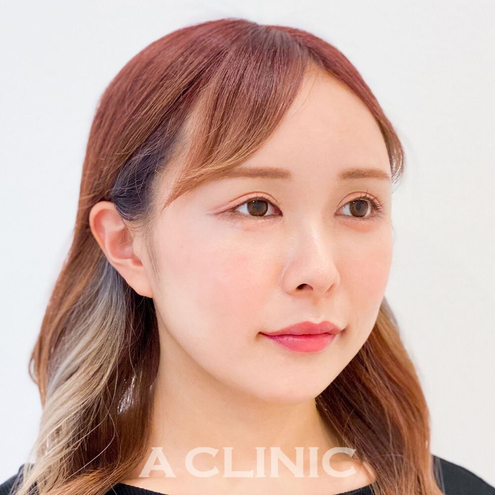 元々小顔の方でも小顔効果を実感！Aスレッド処置前と処置直後です(20代女性) BEFORE