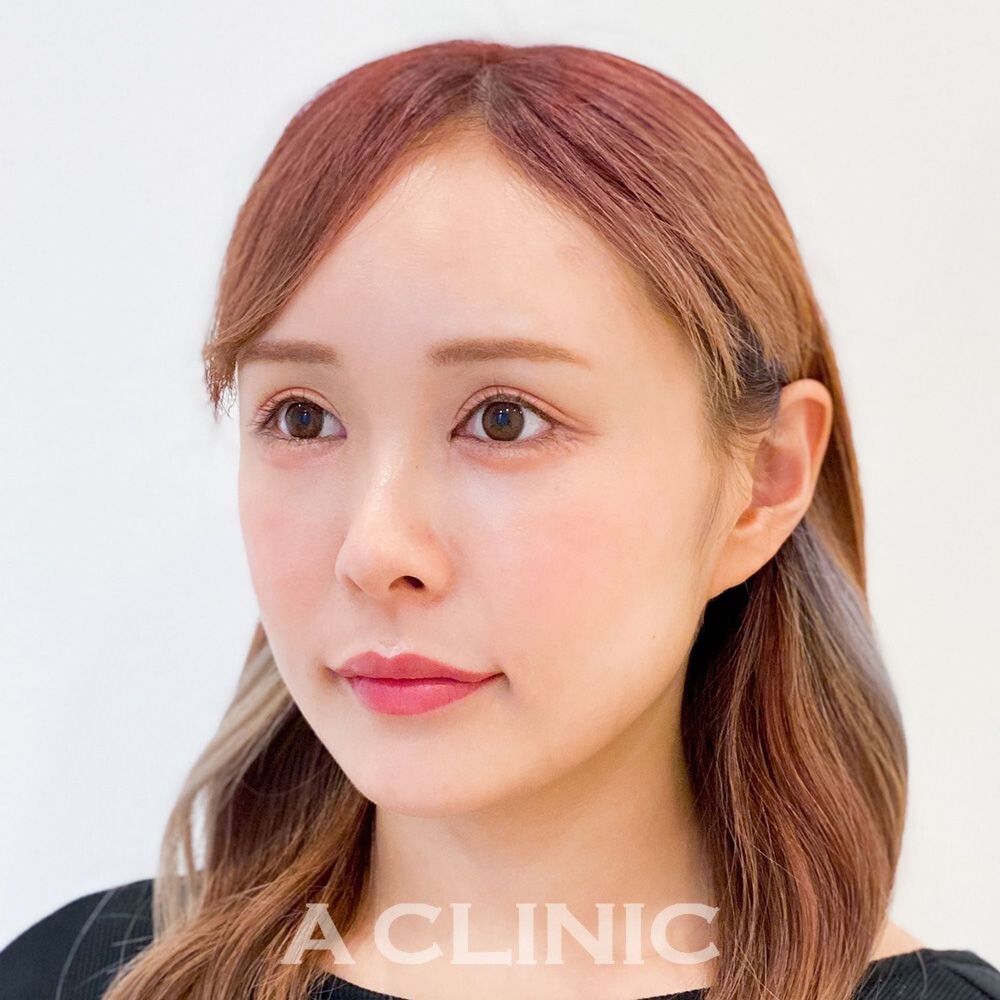 手軽に顔痩せが叶うAスレッド！こちら処置前と処置直後の変化です(20代女性) BEFORE