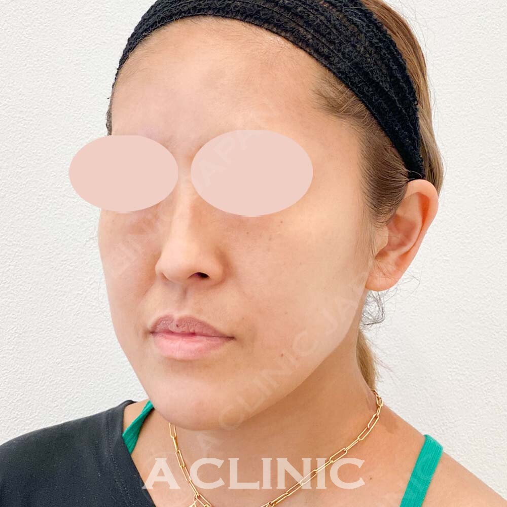 Aスレッドでエラ付近のもたつき解消！こちら処置前と処置直後の症例です(40代女性) BEFORE